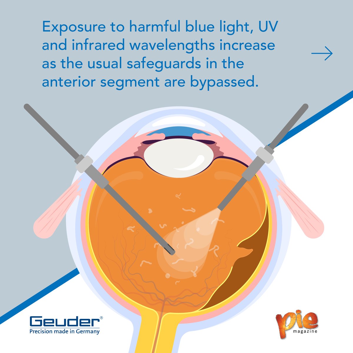 MediaMICEgroup's tweet photo. Laser vitrectomies are blades of light that can save your sight — but there’s a double edge!
Read our newest write up to find out how!
https://t.co/Dm9hweNyM3
#Geuder #SOLEALED #MediaMICE #PIEmagazine #eyesurgery #ophthalmology https://t.co/0K9OhgRqUr