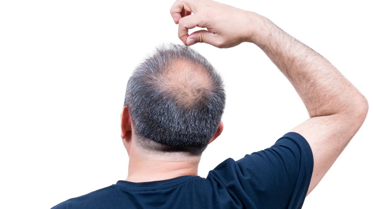 RuberInter's tweet photo. En nuestro blog sobre mitos de dermatología hablamos sobre la #finasterida y el síndrome post-finsterida, el medicamento utilizado para el tratamiento de #alopecia https://t.co/vtH1niz4p1 https://t.co/gDZqHQR8xz