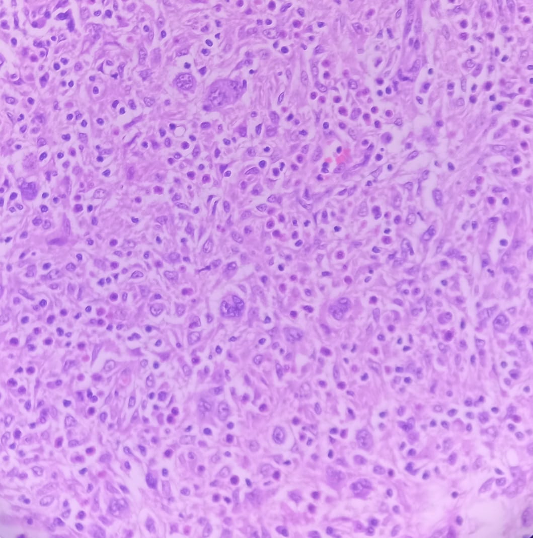 Prachi (@prachipath123) on Twitter photo Sneak peak in classical Hodgkin Lymphoma- Large cells surrounded by mixed cell populations #APCON2022 #APCON2022PathTweet <a href="/AdrianaAncer/">Adriana Ancer</a> <a href="/padmapathology1/">Padma Priya J</a> <a href="/mathuraiims/">Sandeep Mathur</a> <a href="/Swathiprabhu5/">Swathi Prabhu, MD</a> <a href="/Dob_Steino/">Dante</a> <a href="/DrShreyapatho/">shreya subramanian</a> <a href="/Mkpathology/">Meenakshi</a> <a href="/DrAnilaSharma1/">Dr Anila Sharma</a> <a href="/archibhat3/">Archana bhat</a> <a href="/adi_agnihotri/">Aditya Agnihotri 🇮🇳</a> <a href="/DrGeeONE/">Olaleke Folaranmi</a> Sneak peak in classical Hodgkin Lymphoma- Large cells surrounded by mixed cell populations #APCON2022 #APCON2022PathTweet <a href="/AdrianaAncer/">Adriana Ancer</a> <a href="/padmapathology1/">Padma Priya J</a> <a href="/mathuraiims/">Sandeep Mathur</a> <a href="/Swathiprabhu5/">Swathi Prabhu, MD</a> <a href="/Dob_Steino/">Dante</a> <a href="/DrShreyapatho/">shreya subramanian</a> <a href="/Mkpathology/">Meenakshi</a> <a href="/DrAnilaSharma1/">Dr Anila Sharma</a> <a href="/archibhat3/">Archana bhat</a> <a href="/adi_agnihotri/">Aditya Agnihotri 🇮🇳</a> <a href="/DrGeeONE/">Olaleke Folaranmi</a>