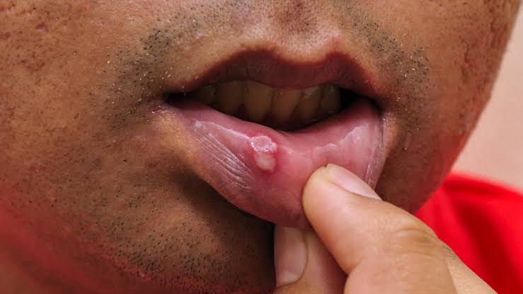 Chief Pharmacist π (@chiefpharmacst) on Twitter photo Pharmacist: What is on your mouth?
Patient : Ah! Na Malaria oo, Heavy one π’!
Fellow Nigerians, that ain't Malaria, that is a sign of ππππππ labialis (also known as πΆππΏπ· πππ
πΈπ).
You may had a Fever, mild headache when you saw it, but it is not Malaria.
A thread Pharmacist: What is on your mouth?
Patient : Ah! Na Malaria oo, Heavy one π’!
Fellow Nigerians, that ain't Malaria, that is a sign of ππππππ labialis (also known as πΆππΏπ· πππ
πΈπ).
You may had a Fever, mild headache when you saw it, but it is not Malaria.
A thread