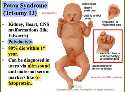 Patau syndrome physical characteristics