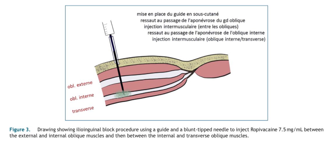 Cirbosque SoMe4Surgery on Twitter "Inguinal hernia repair using the