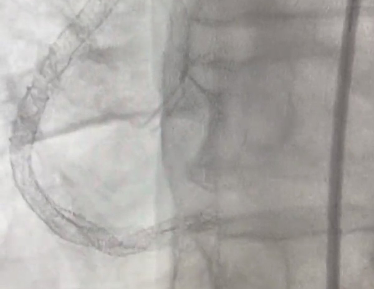 kaschenke's tweet photo. @GhanemAlexander @FabianGocht Truelly an intriguing case. Thanks for posting. The still shot tells quite a story - there is one layer of stent too much, how might it have gotten there? someone put stents in the wrong lumen? #pcicase https://t.co/GCyUw9ji4C