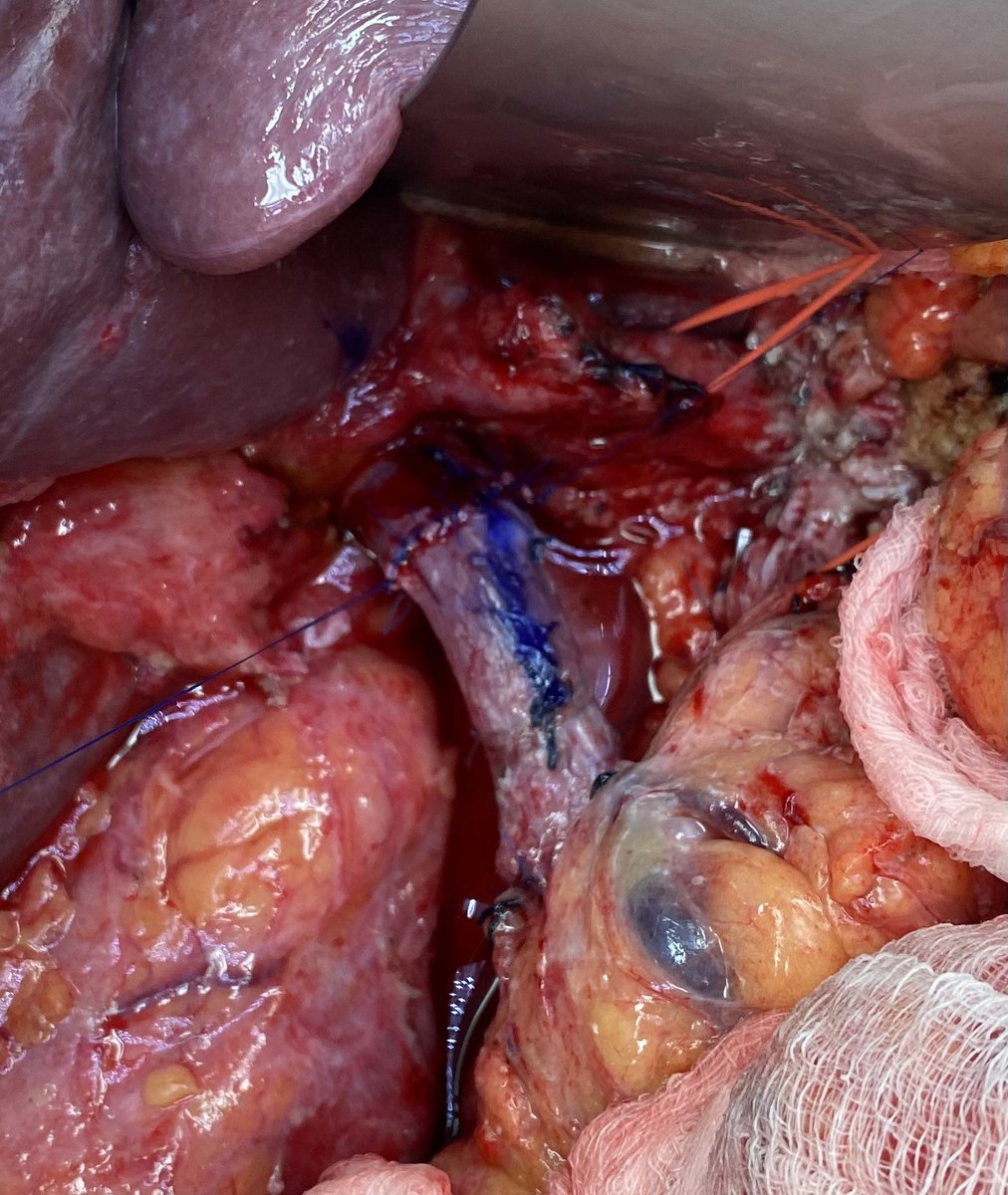 Jason W Denbo (@denbojw) on Twitter photo This week’s venous reconstructions covered the gamut.
Thought an IJ interposition would be necessary for a 3.5cm resection of the PV/SMV confluence…amazing what is amenable to a primary anastomosis after liver mobilization and Cattell-Braasch. <a href="/AHPBA/">AHPBA</a> <a href="/SocSurgOnc/">Society of Surgical Oncology</a> <a href="/PancreasClub/">The Pancreas Club</a> This week’s venous reconstructions covered the gamut.
Thought an IJ interposition would be necessary for a 3.5cm resection of the PV/SMV confluence…amazing what is amenable to a primary anastomosis after liver mobilization and Cattell-Braasch. <a href="/AHPBA/">AHPBA</a> <a href="/SocSurgOnc/">Society of Surgical Oncology</a> <a href="/PancreasClub/">The Pancreas Club</a>