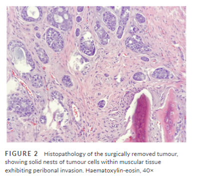 CytopathologyJ's tweet photo. "A039. Metastasis of adenoid cystic carcinoma to a distal lymph node, an exceptionally rare presentation. Reference article (@MauroSaieg): https://t.co/VfAOmFSmYR
#CytoJ #CytoJQuiz #CytoHistoCorrelation #RadPathCorrelation #ENTpath #HeadandNeckPath
" https://t.co/xkMoR31fqP