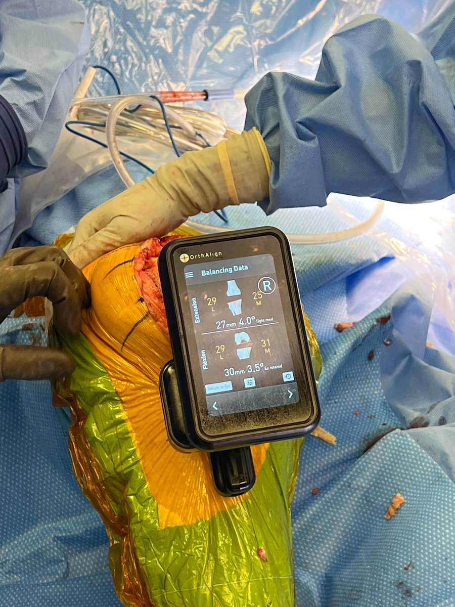 OrthAlign_Inc's tweet photo. Congratulations to @BradWaddellMD for completing his first revision total knee surgery using Lantern Balance!
 
Learn more about Lantern Balance: https://t.co/xfshPeyyKX
 
#orthalign #orthopedicsurgeon #revision #lantern #balance #lightupyouror https://t.co/EDSwSrVhfB