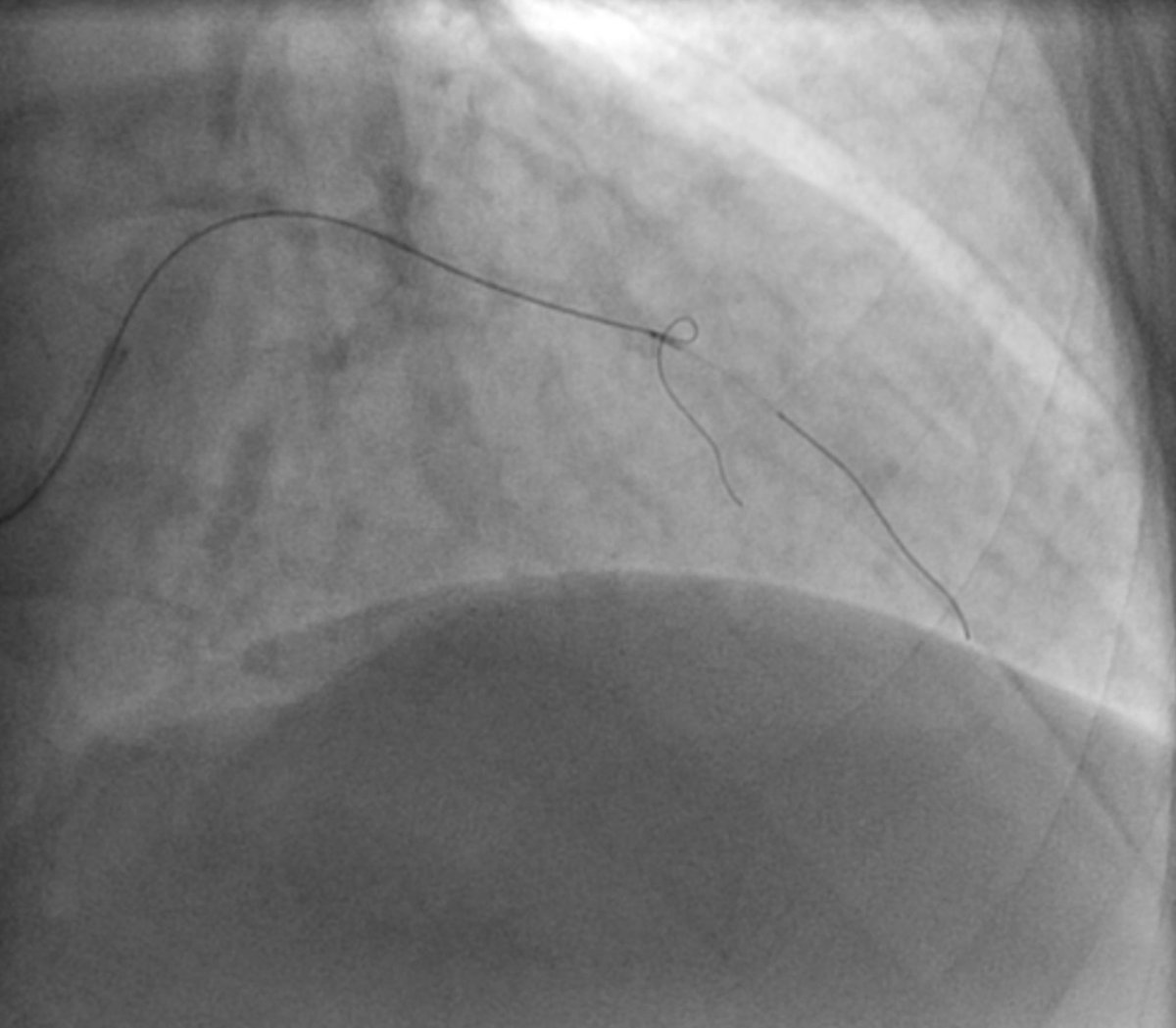 As already suggested <a href="/evandrofilhobr/">Evandro Martins F. MD</a> we went with a dual lumen catheter in mind. 7Fr Guide, 7 Fr Trapliner. P50 in D1 and Sasuke. Difficult to position the Sidehole and with some difficulty managed to wire the LAD with Fielder XTA.