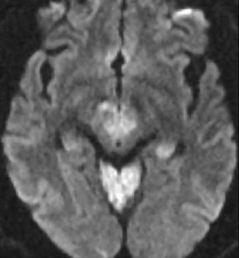 PeteFiesterMD's tweet photo. When a follow-up case on 🧠 #MRI "reads" the textbook 😌 ...
✅ Left: Distal Basilar artery #stroke affecting Red Nuclei.
✅ Right (1 month later): Hypertrophy of Medullary Olives.
#NeuroRadiology #Neurology #RadRes #NeuroRes #NeuroTwitter https://t.co/Kp5L2yEJW4