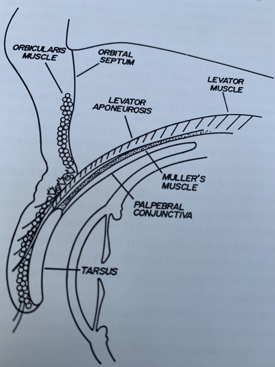 FredLepore's tweet photo. Motor systems should be intact in any apraxia."Apraxia of Lid Opening" (ALO), was described by Cogan in 1965 &amp; the name stuck but all 4 of his pts &amp; all 6 of mine in 1985 had extrapyramidal motor disorders.
I think ALO is an involuntary levator inhibition &amp; not a true apraxia. https://t.co/ec3OknK1FH
