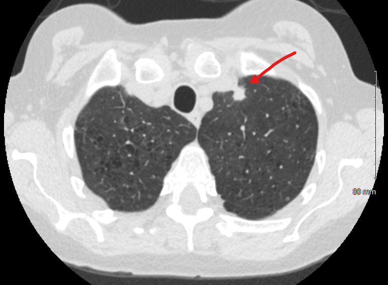 IP Cincinnati (@ipcincy) on Twitter photo Congrats Dr. Keren Mendez. Tough LUL nodule diagnosed with the Monarch robot-assisted navigational bronchoscopy platform. @nochimd <a href="/CRadchenko/">Christopher Radchenko, MD, DAABIP</a> #CincyStrong Congrats Dr. Keren Mendez. Tough LUL nodule diagnosed with the Monarch robot-assisted navigational bronchoscopy platform. @nochimd <a href="/CRadchenko/">Christopher Radchenko, MD, DAABIP</a> #CincyStrong