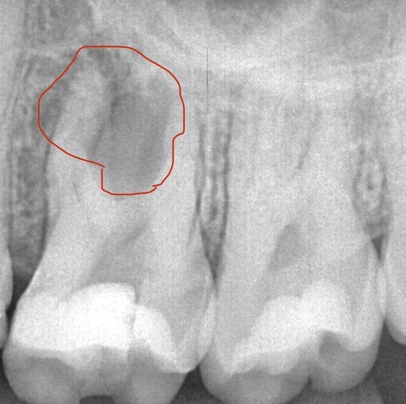 DRTOOTHCLINIC's tweet photo. هذه أحد الحالات لصورة أشعة يظهر خراج تحت الضرس، ونلاحظ إلتئام الخراج وشفاء العظم بعد علاج العصب مع الدكتور وليد المطيري . https://t.co/8t9pQH5tTf