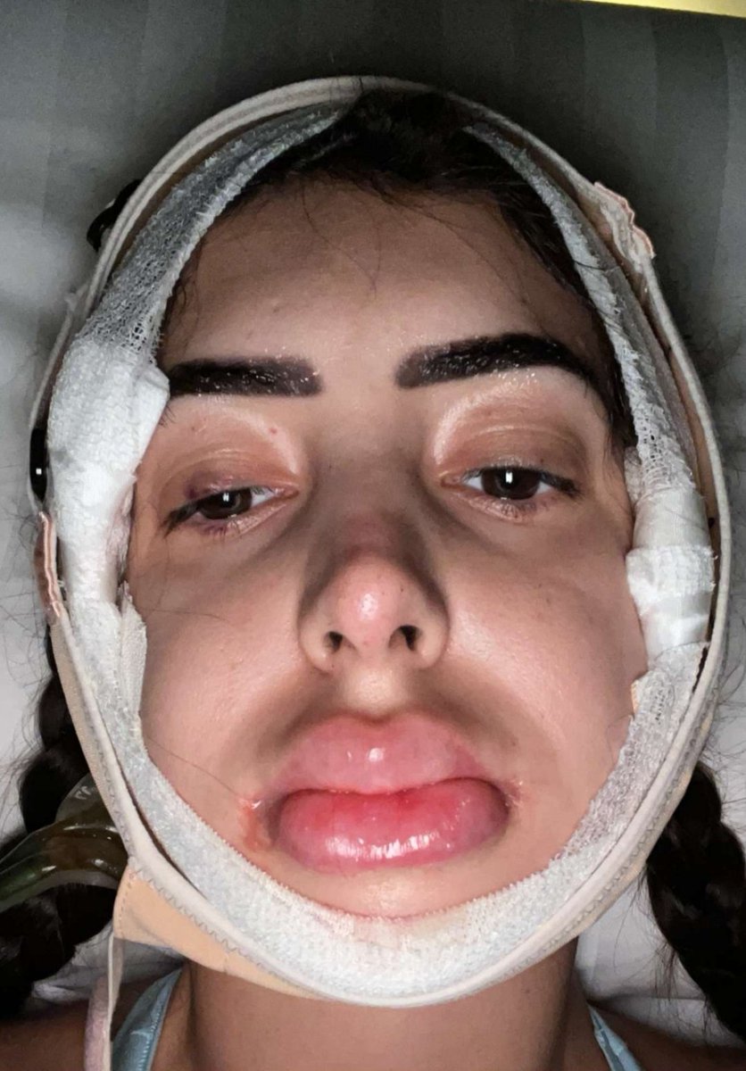 up__news's tweet photo. Après avoir pris d'énormes risques avec une opération pour rattraper un fessier XXL, Léa Mary remet ça avec une chirurgie esthétique... de la mâchoire ! https://t.co/BMVlvpUSXW