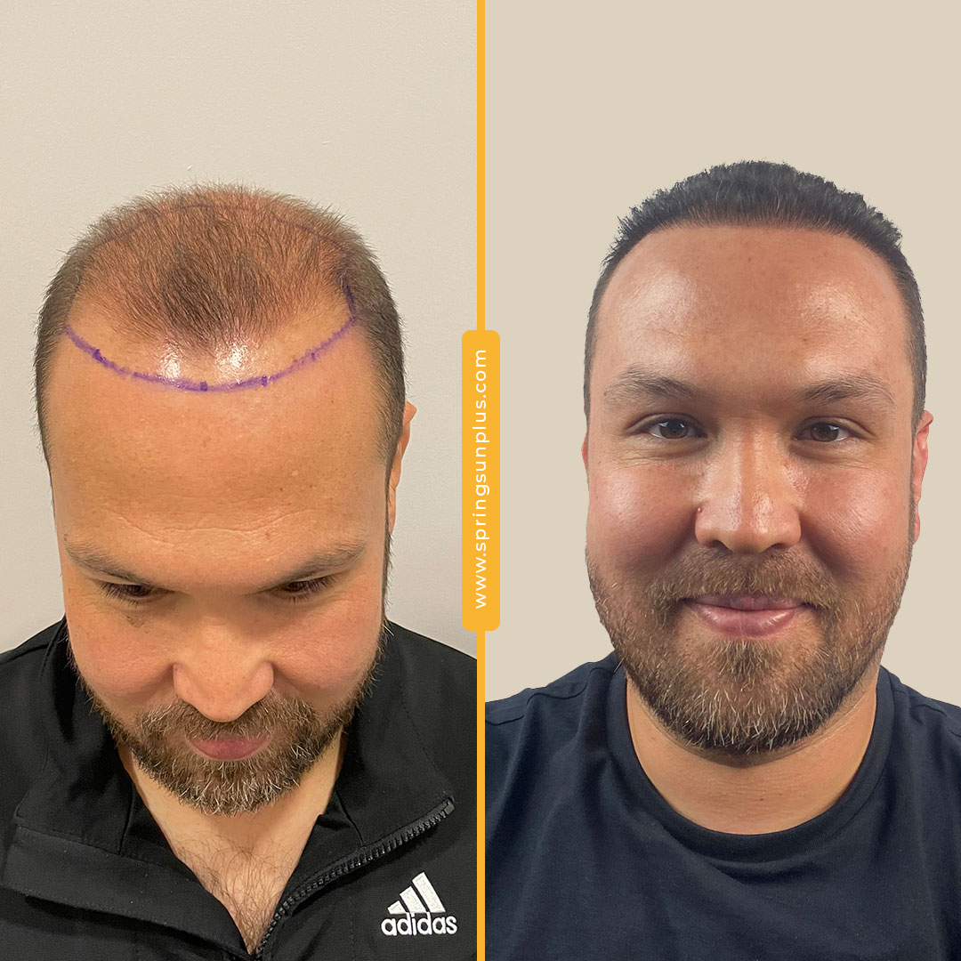 springsunplus's tweet photo. Hair transplantation operation in Turkey
#hairtransplantation #hairtransplantation #haartransplantation #trasplantecapilar #greffedecheveux #springsunplus #turkey #healthtourism https://t.co/pBNRkgm1Gn