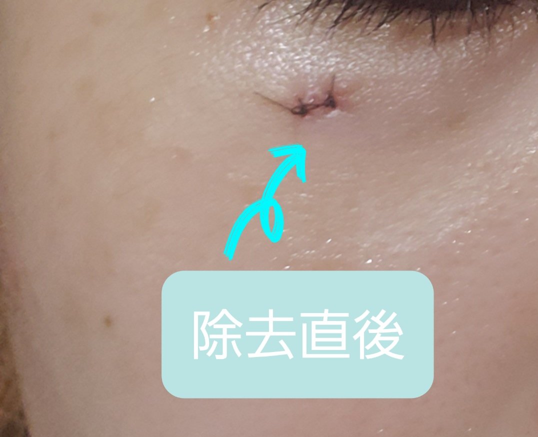 napiii2's tweet photo. 顔のほくろ除去の記録✍️

写真:加工は文字・スッピン🙏🏻
1枚目→取りたかったほくろ
2枚目→除去直後
3枚目→抜糸直後
4枚目→抜糸から1週間経過した傷あと(現在)

⚠かかる病院・クリニックよって差、また個人差があると思います。なによりも医師の診断・指導に従事を

ツリーに続きあり⤵︎ https://t.co/6vEW5hBxAQ