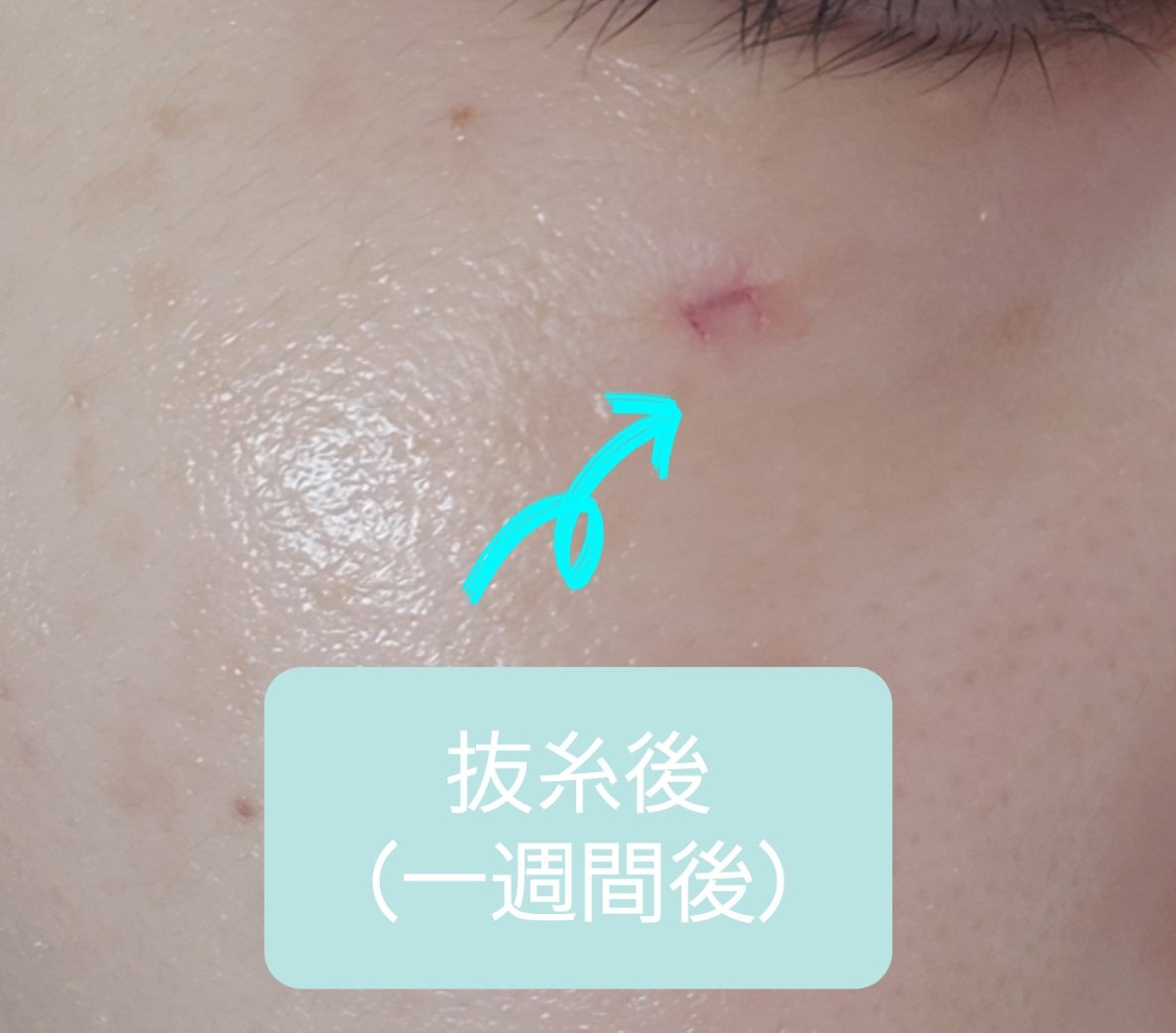 napiii2's tweet photo. 顔のほくろ除去の記録✍️

写真:加工は文字・スッピン🙏🏻
1枚目→取りたかったほくろ
2枚目→除去直後
3枚目→抜糸直後
4枚目→抜糸から1週間経過した傷あと(現在)

⚠かかる病院・クリニックよって差、また個人差があると思います。なによりも医師の診断・指導に従事を

ツリーに続きあり⤵︎ https://t.co/6vEW5hBxAQ
