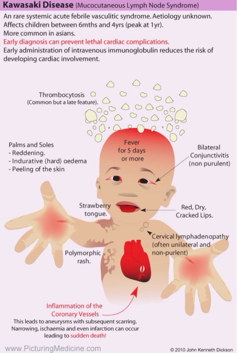 Kawasaki Disease Symptoms Poster Icu Rn Kawasaki Disease Disease My