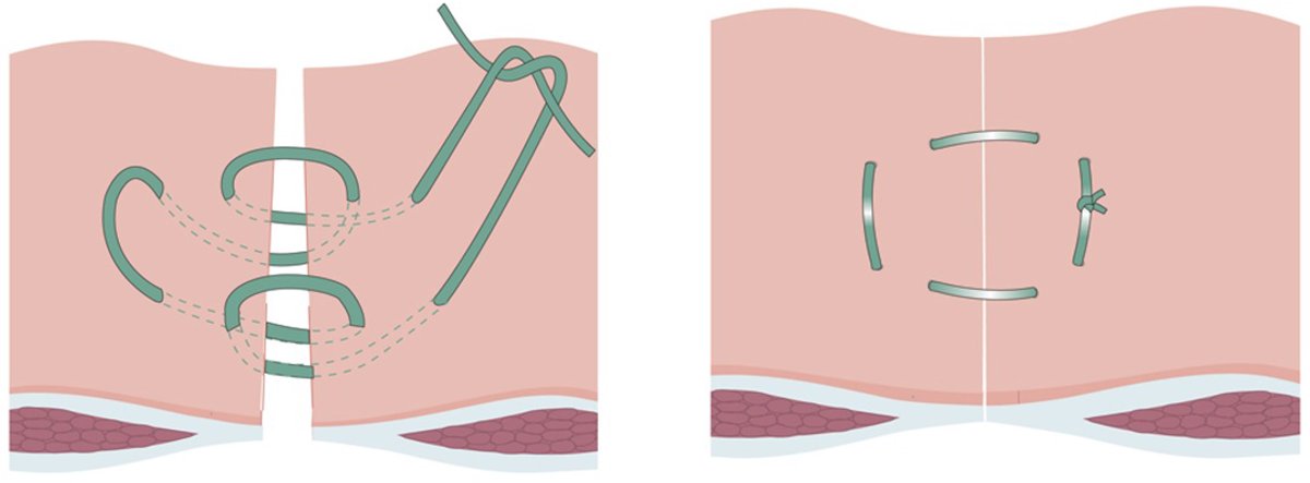 Open Access in BJS' October issue: Incisional hernia following colorectal cancer surgery according to suture technique:Hughes Abdominal RCT (HART) academic.oup.com/bjs/article/10… @AmyLightnerMD @bplwijn @des_winter @ksoreide @MalinASund @evanscolorectal @nfmkok @robhinchliffe1 @young_bjs