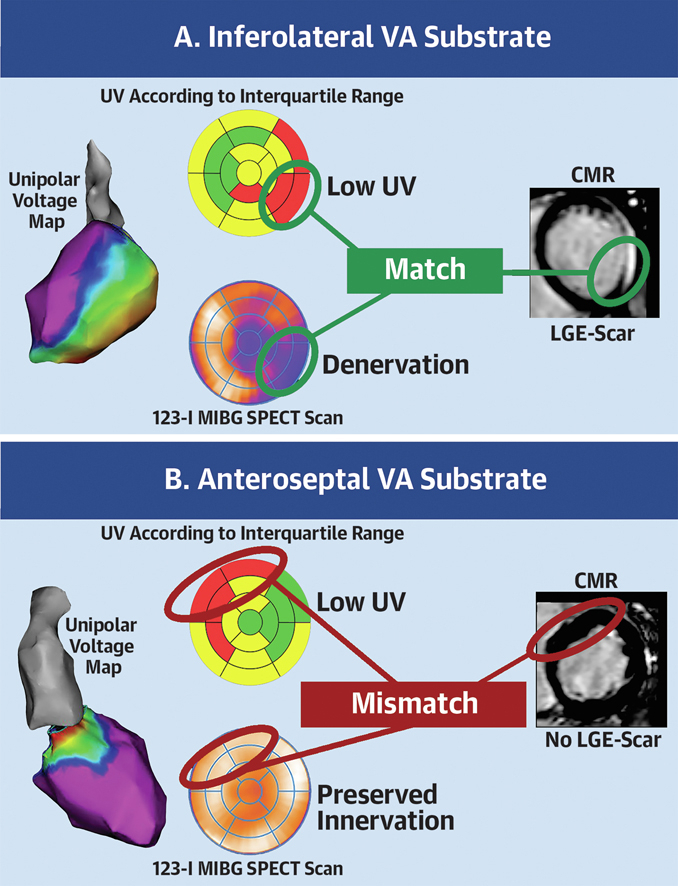 Check out our latest research paper in press in #JACCEP on ventricular arrhythmia substrate distribution and its relation to sympathetic innervation in NICM! @C_Jungen @KatjaZeppenfeld @PiersSebastiaan @EP_Leiden jacc.org/doi/10.1016/j.… #EPeeps #WECAM #CAHAL #LUMC