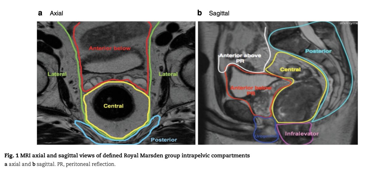 🆕👥#CollaborativeResearch and #Guideline in BJS: Minimum standards of pelvic exenterative practice: PelvEx Collaborative guideline

🔗academic.oup.com/bjs/advance-ar…

#SoMe4Surgery