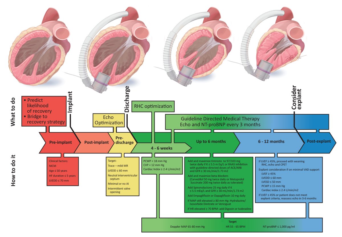 Companion State of the Art reviews in #JHLT on science and art of myocardial recovery with LVAD. @PalakShahMD @StavrosDrakos @tonkhueMdPhd @BurkhoffMd @rlkkvad51 @MRMehraMD @TheJHLT @Gracedan10_99 @AHN_CVI @UCARS_recovery jhltonline.org/article/S1053-… and jhltonline.org/article/S1053-….