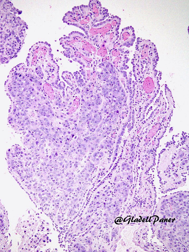GladellPaner's tweet photo. #GUPath tweeps, is there 1 or 2 pathologies in this #bladder TUR? https://t.co/XuAe1GuiTs