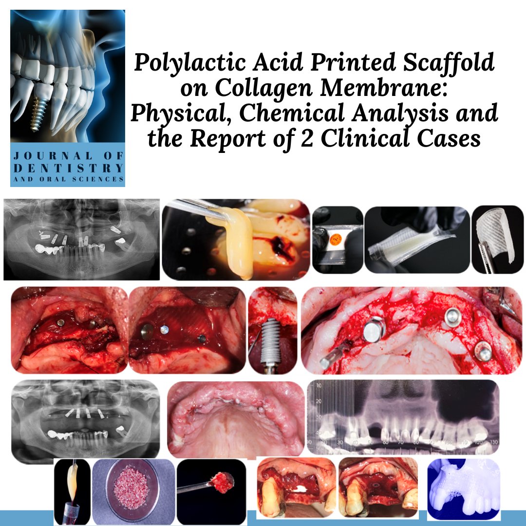 Recent publication: Polylactic Acid Printed Scaffold on Collagen Membrane: Physical, Chemical Analysis and the Report of 2 Clinical Cases
Read the full-length paper via following link: maplespub.com/article/polyla…
Submit your paper for next issue at dentistry@mapsci.org
 #clinicalcase