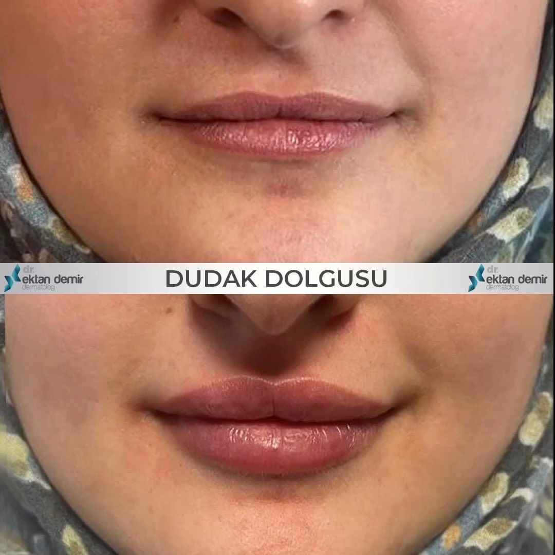 👄DUDAK DOLGUSU👄

💊 Anestezi: Bölgesel
😨 Ağrı : Minimal
⏰ Süre: 15-20 dakika
⏳ Kalıcılık: 12 ay
🔖 Randevu: 0532 572 54 44
📍 Yer: Ataşehir Deluxia Palace
⚠️Uzman Dr. Tarafından yapılmalıdır!
ektandemir.com/dudak-dolgusu/

#dudakdolgusu #lipfiller #dudakdolgusuistanbul #istanbul
