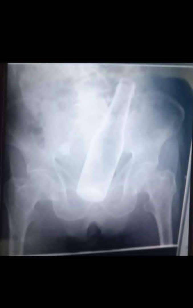 InforTvenezuela's tweet photo. Un adulto de 79 años fue ingresado de emergencia al hospital IVSS para extraerle una botella que tenía en su recto.
Al practicarle una radiografía,para la sorpresa de los médicos,se trataba de una botella,por lo que fue ingresado de inmediato al quirófano.
Palo Negro,edo Aragua https://t.co/IaRUWo9OnF