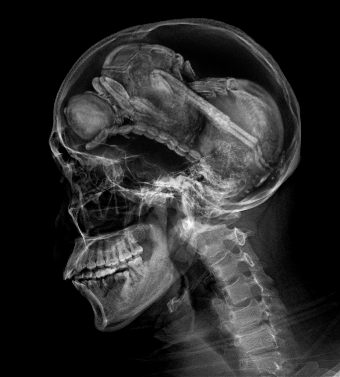 Human host infested by the parasitoid wasp Euderus cephalophaga.
The wasp lays its egg under the skull. The larva then eats the brain tissue over years, mimicking its nerve signals to keep the host alive. Once it replaces the brain, it moults into its final form, ready to hatch.