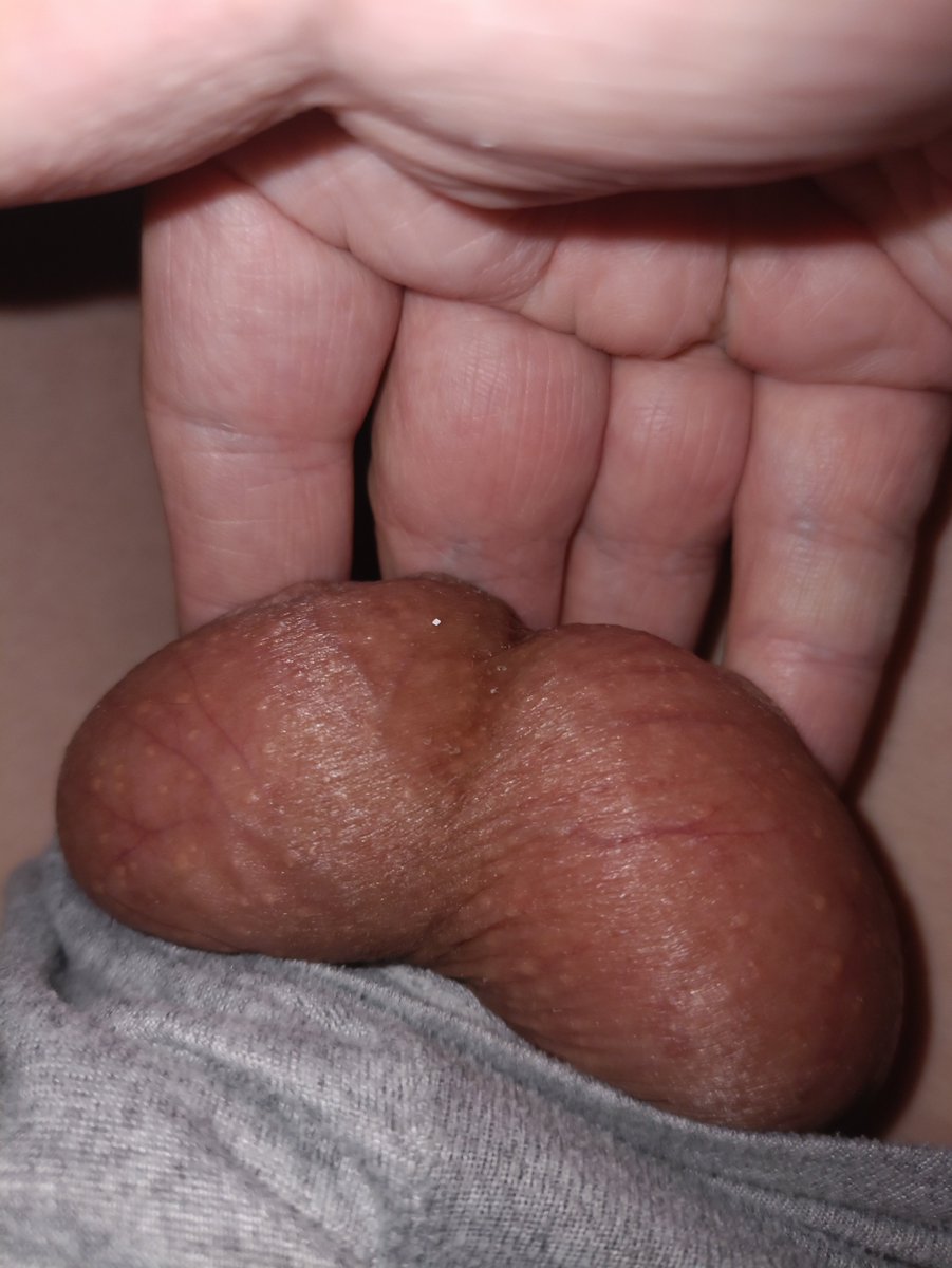 handsherm's tweet photo. #虐蛋 #踩蛋 #穿刺 #阉割 #踢蛋  #精牛 #睾丸  #CBT  #球 #爆蛋  #SM #性瘾患者  想玩加主页q https://t.co/EOJ9iWXcAj