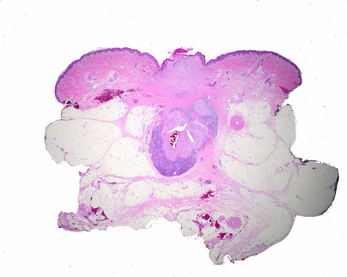 LizMontgomeryMD's tweet photo. A nice angiomatoid fibrous histiocytoma to enjoy. https://t.co/onsMjf3Ojx