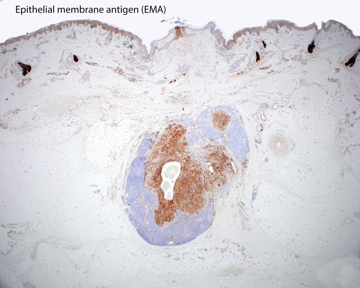 LizMontgomeryMD's tweet photo. A nice angiomatoid fibrous histiocytoma to enjoy. https://t.co/onsMjf3Ojx