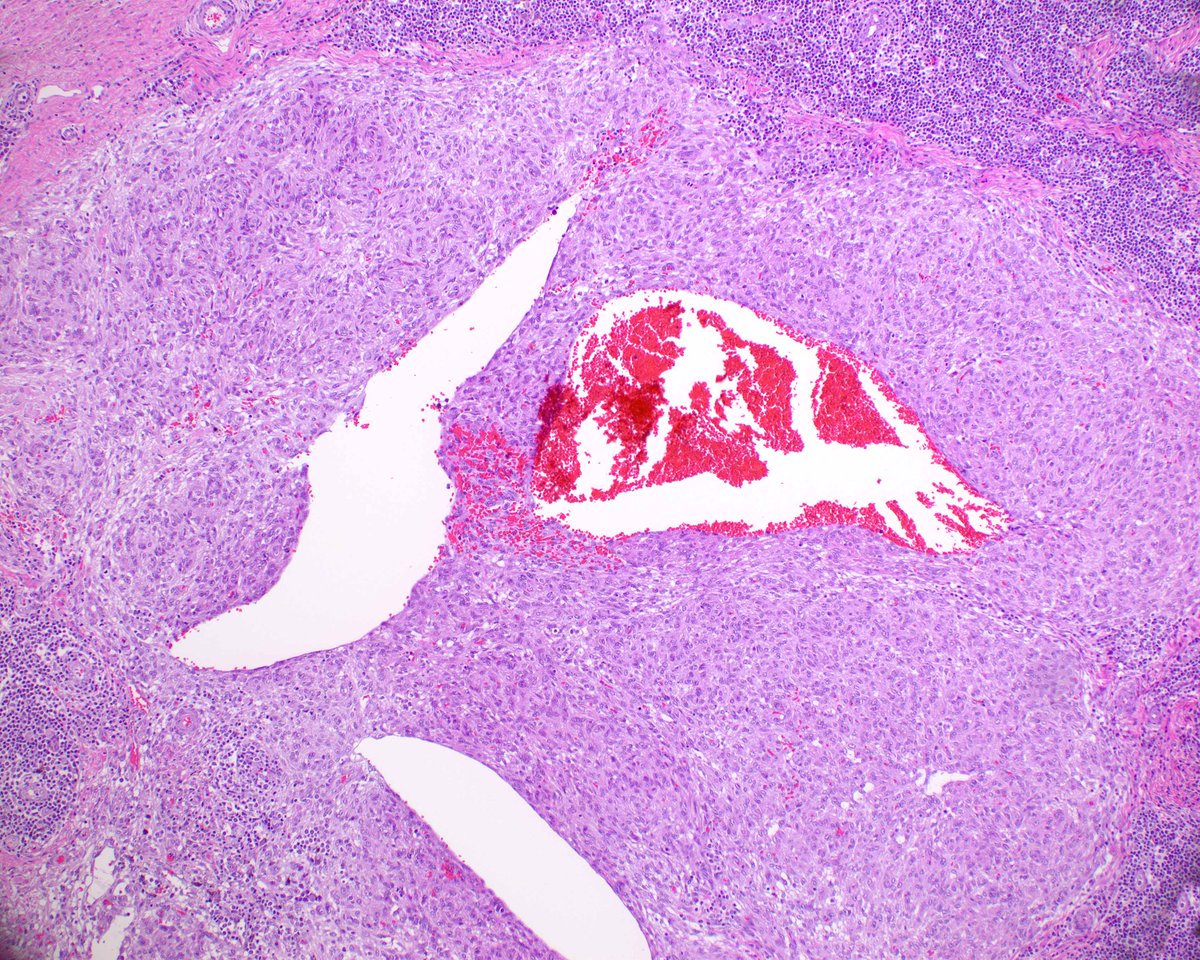 LizMontgomeryMD's tweet photo. A nice angiomatoid fibrous histiocytoma to enjoy. https://t.co/onsMjf3Ojx