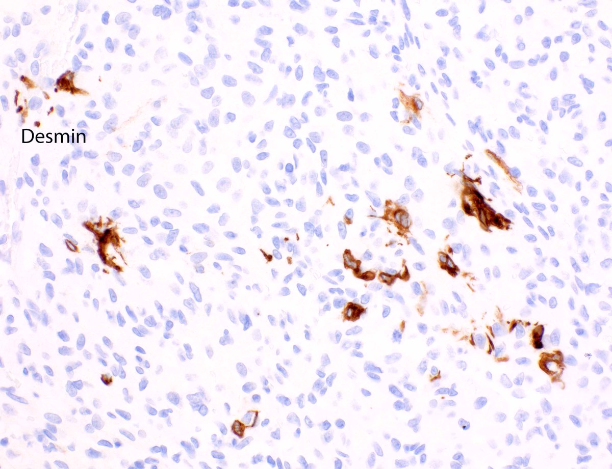 LizMontgomeryMD's tweet photo. A nice angiomatoid fibrous histiocytoma to enjoy. https://t.co/onsMjf3Ojx