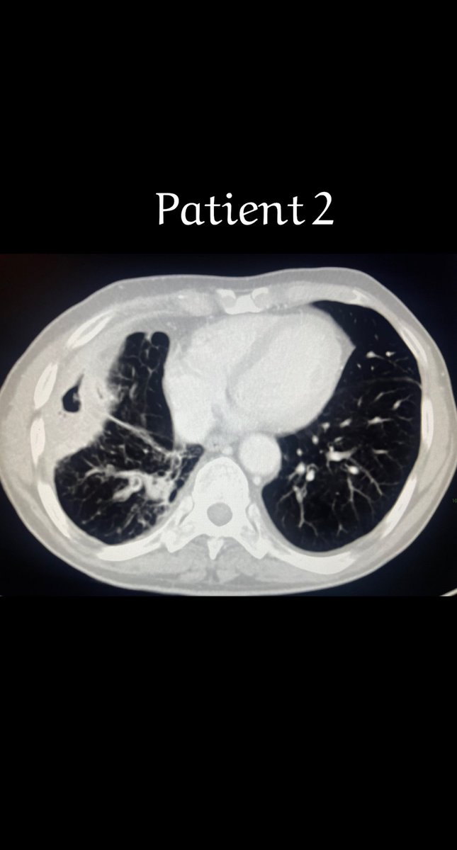 Adeebmsg's tweet image. نفث الدم ( كثرة خروج الدم مع السعال ) قد يؤدي للوفاه بسبب الاختناق وانسداد الشعب الهوائية بالدم بالاضافه للنقص الحاد في خضاب الدم.
صور توضح علاج مريضين بالقسطره عن طريق حقن مادة تساهم في اغلاق شريان الشعب الهوائية وبالتالي توقف بصق الدم.
@ksmcmedia