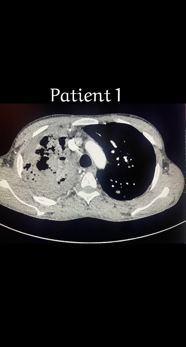 Adeebmsg's tweet image. نفث الدم ( كثرة خروج الدم مع السعال ) قد يؤدي للوفاه بسبب الاختناق وانسداد الشعب الهوائية بالدم بالاضافه للنقص الحاد في خضاب الدم.
صور توضح علاج مريضين بالقسطره عن طريق حقن مادة تساهم في اغلاق شريان الشعب الهوائية وبالتالي توقف بصق الدم.
@ksmcmedia