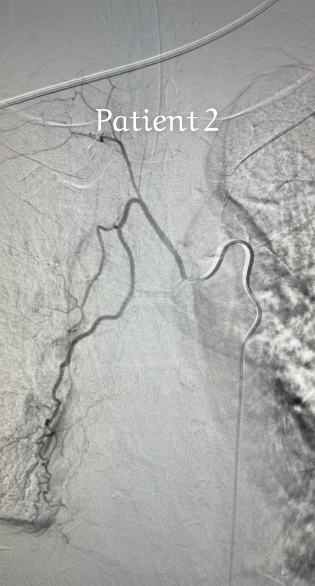 Adeebmsg's tweet image. نفث الدم ( كثرة خروج الدم مع السعال ) قد يؤدي للوفاه بسبب الاختناق وانسداد الشعب الهوائية بالدم بالاضافه للنقص الحاد في خضاب الدم.
صور توضح علاج مريضين بالقسطره عن طريق حقن مادة تساهم في اغلاق شريان الشعب الهوائية وبالتالي توقف بصق الدم.
@ksmcmedia