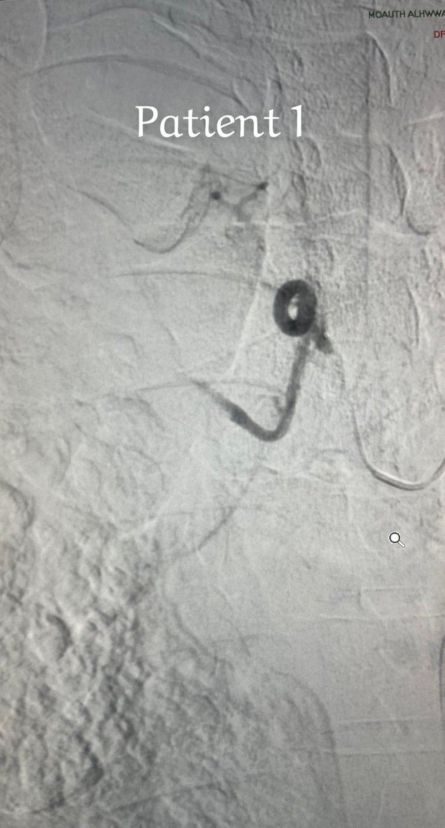 Adeebmsg's tweet image. نفث الدم ( كثرة خروج الدم مع السعال ) قد يؤدي للوفاه بسبب الاختناق وانسداد الشعب الهوائية بالدم بالاضافه للنقص الحاد في خضاب الدم.
صور توضح علاج مريضين بالقسطره عن طريق حقن مادة تساهم في اغلاق شريان الشعب الهوائية وبالتالي توقف بصق الدم.
@ksmcmedia