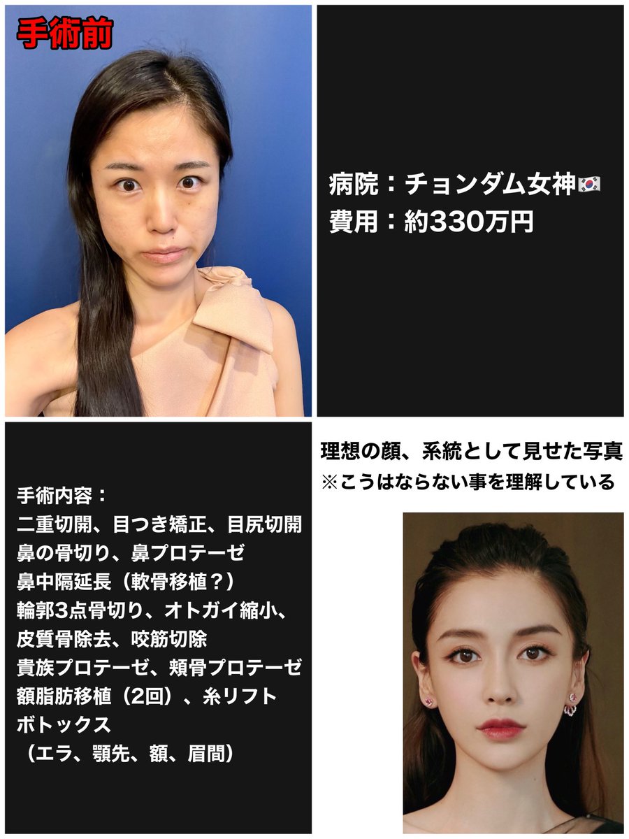 misachasu0209's tweet photo. 【拡散希望】顔を「先生のおまかせ」で約330万円かけ全部整形しました。1週間の経過写真。骨まで切ってまだ腫れまくってます。私は一体これからどうなるのか？RTで応援いただけましたら嬉しいです！！ https://t.co/plU44egBrM