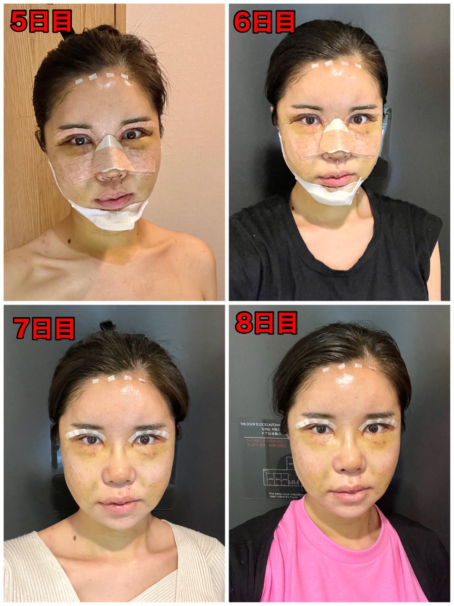 【拡散希望】顔を「先生のおまかせ」で約330万円かけ全部整形しました。1週間の経過写真。骨まで切ってまだ腫れまくってます。私は一体これからどうなるのか？RTで応援いただけましたら嬉しいです！！