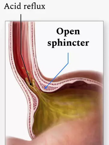 USMLEStepStudy's tweet photo. Gastroesophageal reflux disease (GERD) manifestations: heartburn, regurgitation, chronic cough, globus sensation, wheezing, posterior laryngitis, dental erosions, idiopathic pulmonary fibrosis. Risk factors - 50 y/o+, smoking, NSAIDs, obesity, low socioeconomic status, female sex https://t.co/3WSySzpxcI