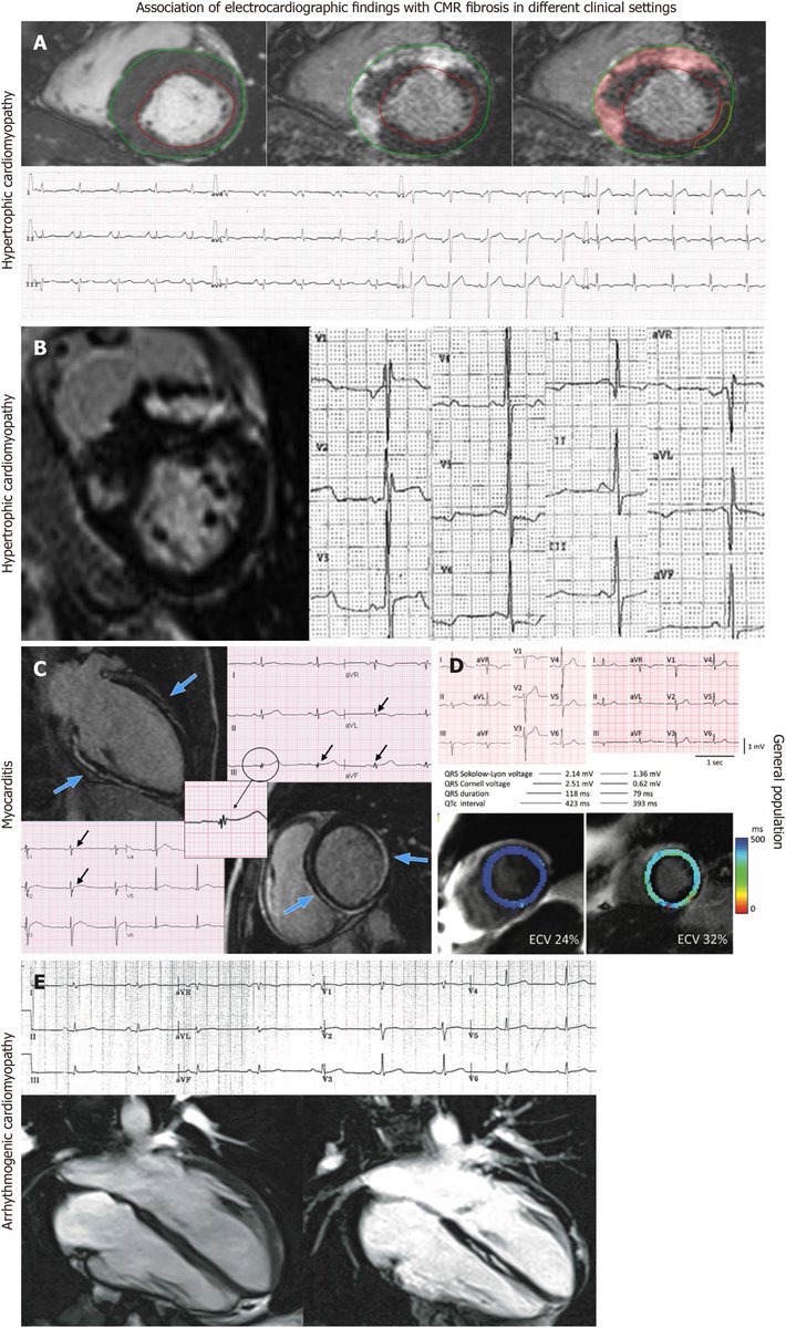 Göksel Çinier (@gokselcinier) on Twitter photo Privileged to collaborate w/ this talented people within <a href="/ISE_YCommunity/">ISE Young Community</a>
Check out our latest paper lead by <a href="/GBazoukis/">George Bazoukis</a>
We performed a systematic review for ECG markers related to myocardial fibrosis assessed by CMR
bit.ly/3ftSbmL
<a href="/adribaran/">Adrian Baranchuk MD FACC FRCPC FCCS FSIAC</a> <a href="/sebagz1/">Seba GZ, MD, MSc</a> <a href="/GaryTse1/">Gary Tse</a> Privileged to collaborate w/ this talented people within <a href="/ISE_YCommunity/">ISE Young Community</a>
Check out our latest paper lead by <a href="/GBazoukis/">George Bazoukis</a>
We performed a systematic review for ECG markers related to myocardial fibrosis assessed by CMR
bit.ly/3ftSbmL
<a href="/adribaran/">Adrian Baranchuk MD FACC FRCPC FCCS FSIAC</a> <a href="/sebagz1/">Seba GZ, MD, MSc</a> <a href="/GaryTse1/">Gary Tse</a>