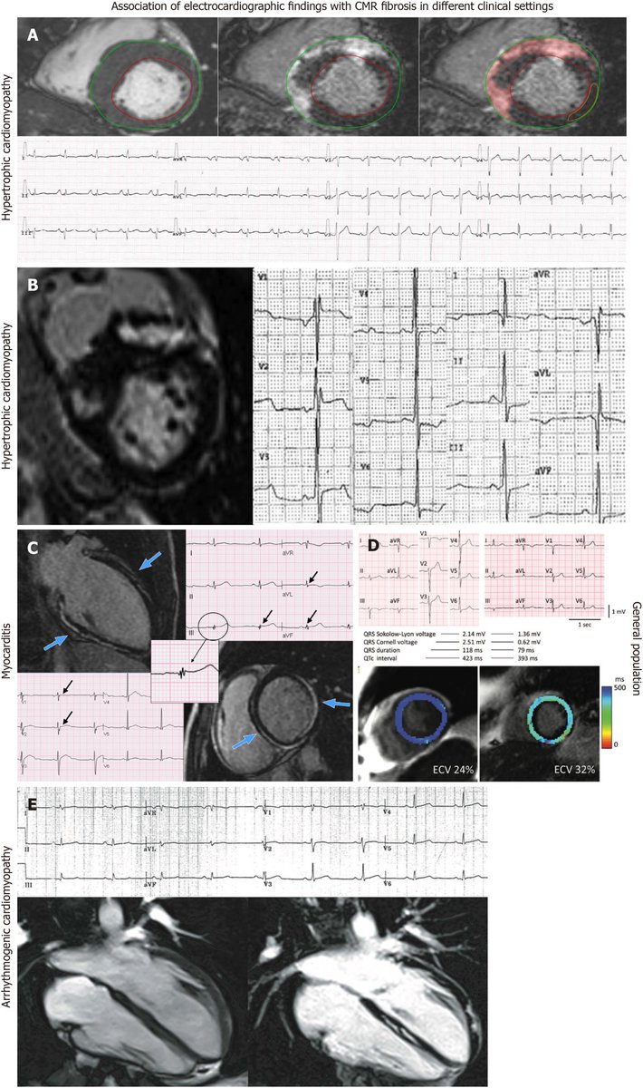 Privileged to collaborate w/ this talented people within @ISE_YCommunity Check out our latest paper lead by @GBazoukis We performed a systematic review for ECG markers related to myocardial fibrosis assessed by CMR bit.ly/3ftSbmL @adribaran @sebagz1 @GaryTse1