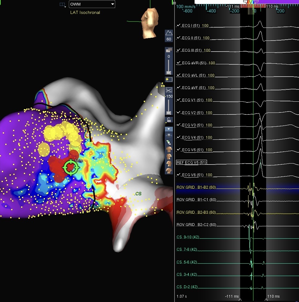 AbbottEP_LA's tweet photo. Redo WPW in a patient with Hx of AF. Open-window mapping with #HDGrid created a very close, but distinct delineation between the his signal and the conducting AP. Eliminated antegrade conduction with the first RF lesion. EGM at his and term site displayed. #AbbottEP @krall_amanda https://t.co/3guU19aNtL