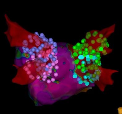 Marvin Lu (@marvlu) on Twitter photo Learning Fluoroless PFA with <a href="/ampatelmd/">Anshul M. Patel, MD</a> at <a href="/emoryheart/">Emory Cardiology</a>. <a href="/emory_heart/">Emory Cardiology Fell🫀ws</a> @BiosenseWebster #VARIPULSE #EPeeps Learning Fluoroless PFA with <a href="/ampatelmd/">Anshul M. Patel, MD</a> at <a href="/emoryheart/">Emory Cardiology</a>. <a href="/emory_heart/">Emory Cardiology Fell🫀ws</a> @BiosenseWebster #VARIPULSE #EPeeps