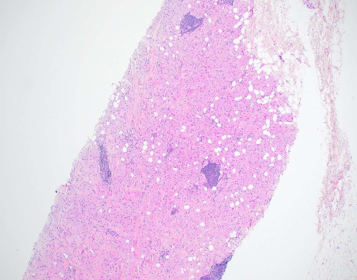 SunyUpstate's tweet photo. 43 yo female with a breast lump. The biopsy is shown below. What is your diagnosis? What stains might you order? #PathTwitter #BreastPath https://t.co/hq8P54lSbi