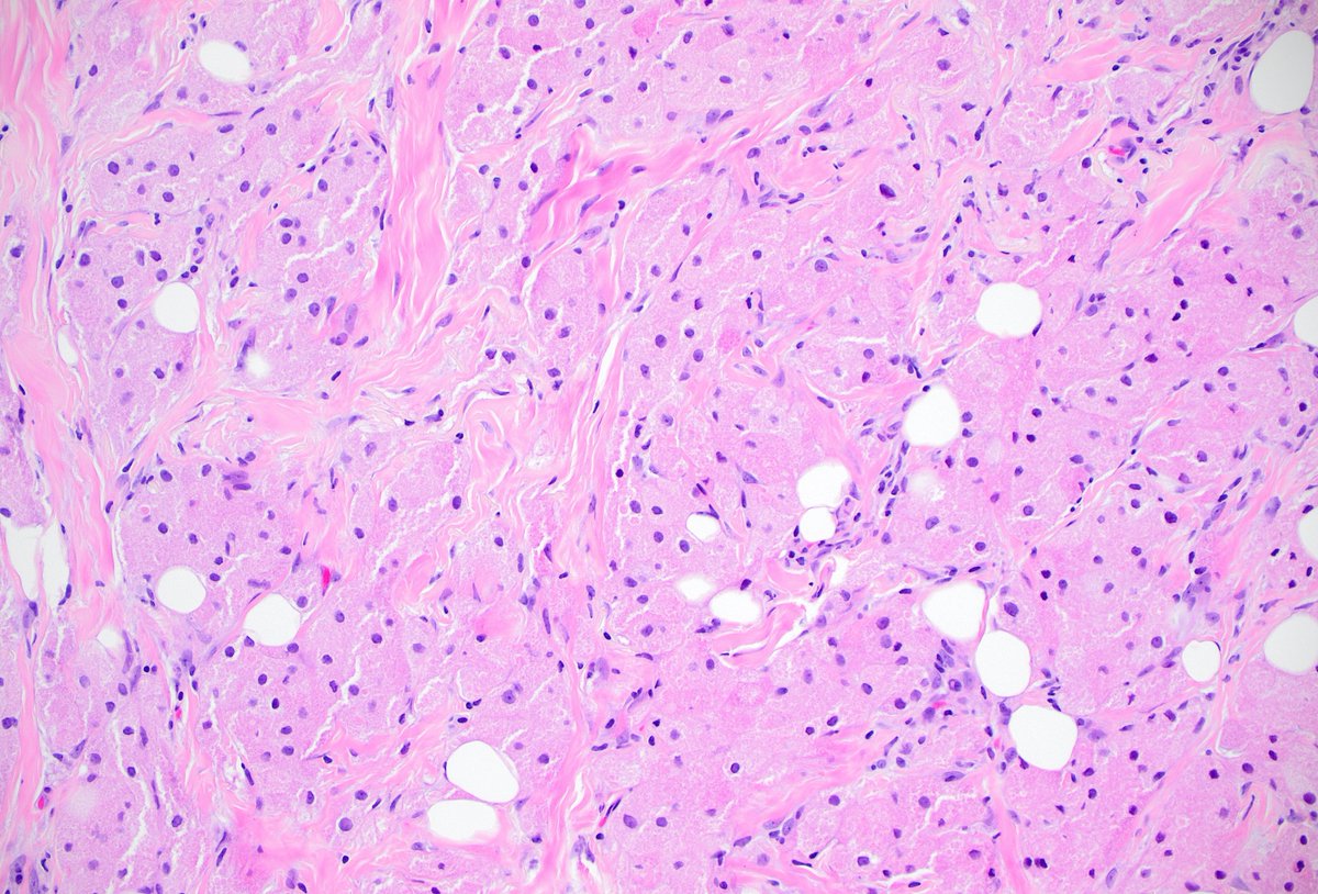 SunyUpstate's tweet photo. 43 yo female with a breast lump. The biopsy is shown below. What is your diagnosis? What stains might you order? #PathTwitter #BreastPath https://t.co/hq8P54lSbi