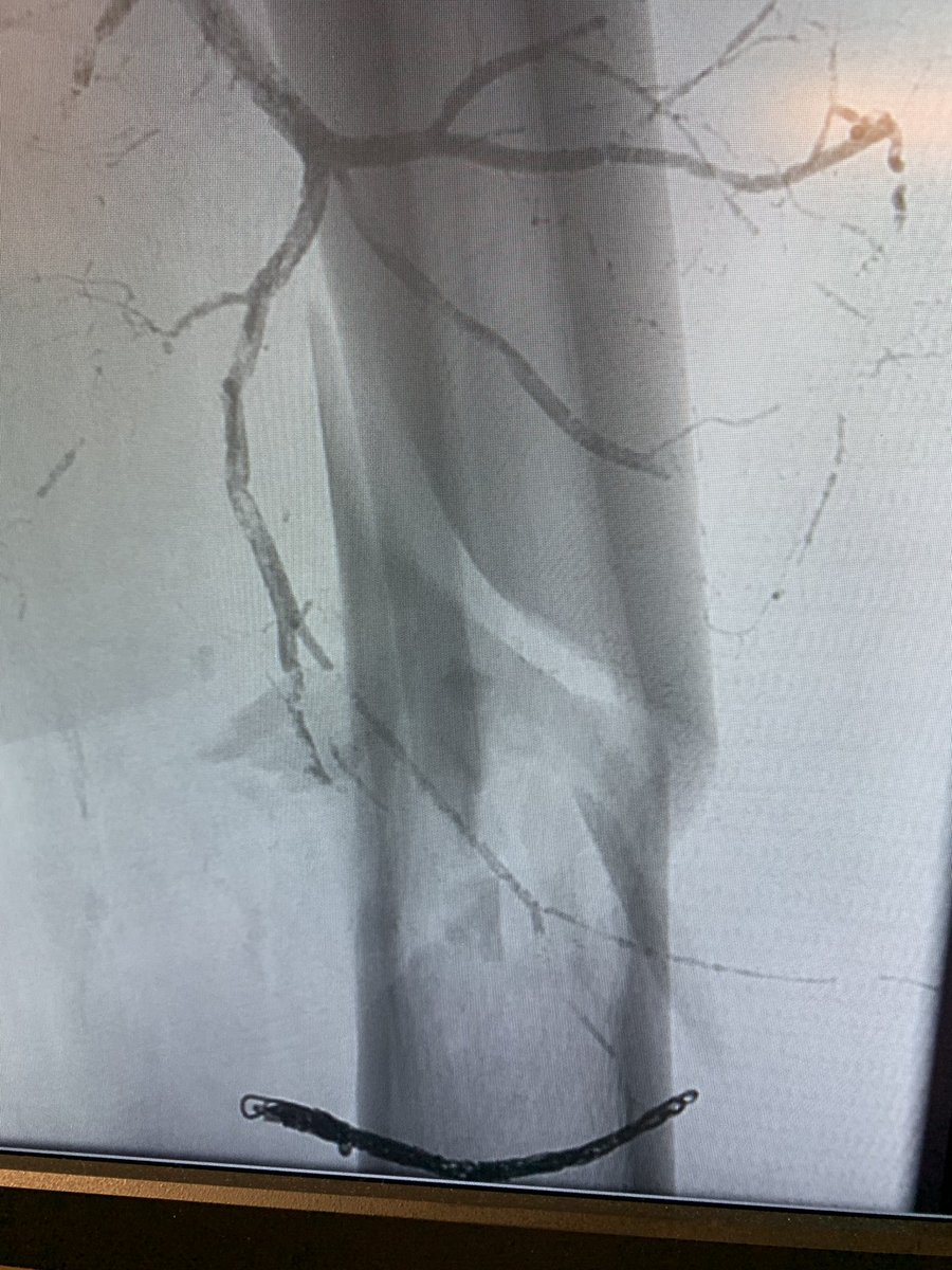 CharlesLugo007's tweet photo. RCC pathologic fracture—> preop embo. I used penumbra coils to embolize the arterial feeder arising from the SFA and NBCA from the profunda feeders. @MiamiVasc @drvarshana @PenVascular @RajNarayanan67 @KutsenkoMD @BlakeJacks https://t.co/2yJaZmiAZH