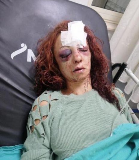Bu kadını sopayla ve bıçakla bu hale getiren HasansevincerTutuklanmalı.Haa.. adaletin tahakkuku için devletimiz bu caniyi de aynı şekilde işkence etmelidir.şeriat ne diyor:öldüren öldürülmeli,işkence eden işkence görmeli.bu da devletin yapması lazım.yoksa sonlanmaz bu olaylar.