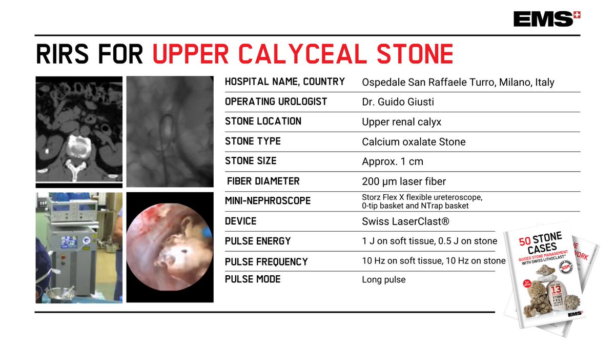 EMSUrology's tweet photo. Great RIRS case with the original Swiss #LaserClast: 1 cm calcium oxalate stone located in the upper renal calyx.

The video is courtesy of @GuidoGiusti Contact us for our new eBook ✍

https://t.co/IdSCSDUfZk https://t.co/tttEYOcRo7
